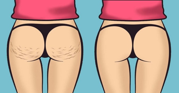 end-of-cellulite
